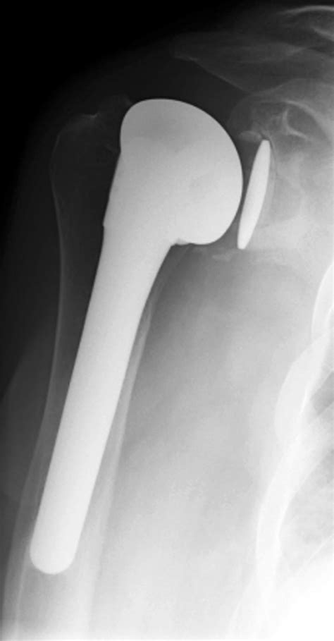 right total shoulder arthroplasty icd 10|aftercare shoulder arthroplasty icd 10.